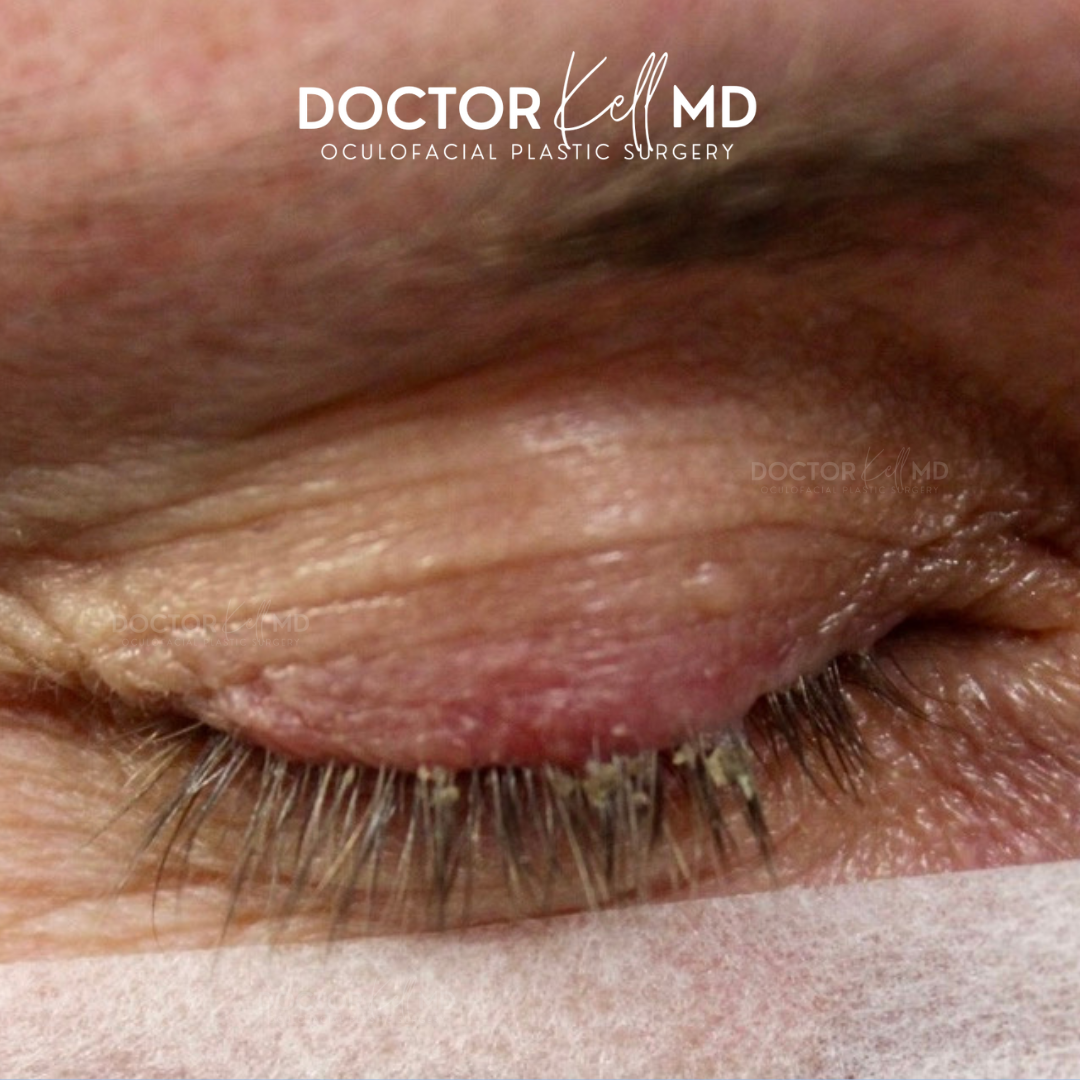 Chalazions / Styes in San Diego, CA | San Diego Eye & Face