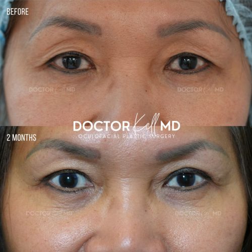 Asian Blepharoplasty San Diego