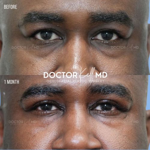 Male Upper Lid Blepharoplasty in San Diego
