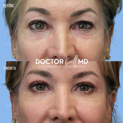 BUL-ptosis