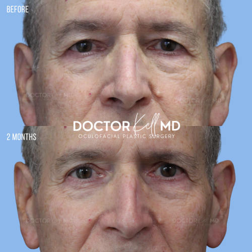Bilateral Upper Lid Blepharoplasty in San Diego