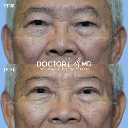 Male Asian Upper Blepharoplasty in San Diego