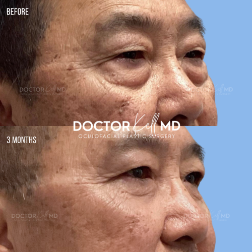 Asian Male Bilateral Upper and Lower Lid Blepharoplasty in San Diego