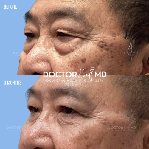 Asian Male Bilateral Upper and Lower Lid Blepharoplasty in San Diego