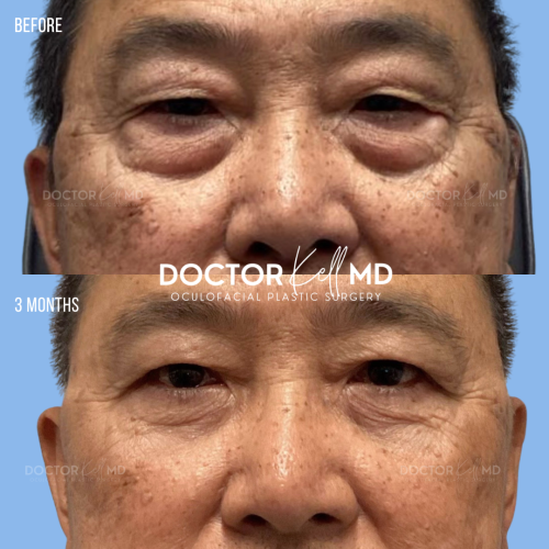 Male Asain Upper Blepharoplasty in San Diego