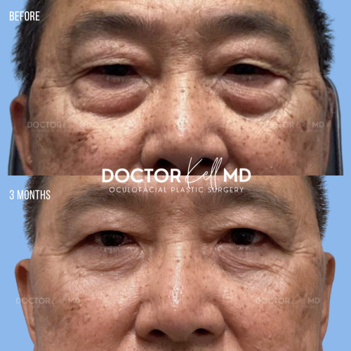 Asian Male Bilateral Upper and Lower Lid Blepharoplasty in San Diego