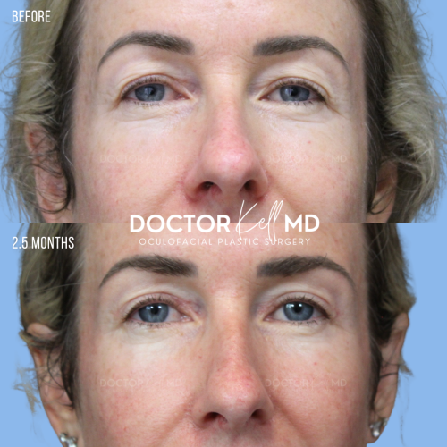 Bilateral Upper Lid Blepharoplasty in San Diego