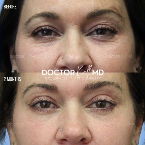 Bilateral Upper Lid Blepharoplasty in San Diego