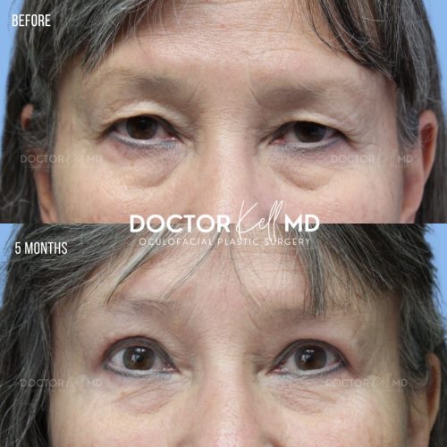 Asian Eyelid Blepharoplasty in San Diego 