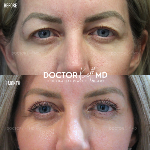 Bilateral Upper Lid Blepharoplasty in San Diego