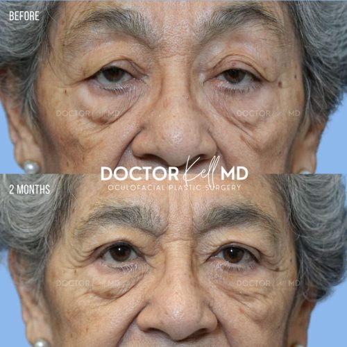 Bilateral Upper Lid Blepharoplasty in San Diego