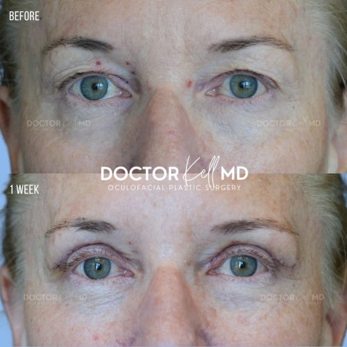 Bilateral Upper Lid Blepharoplasty in San Diego
