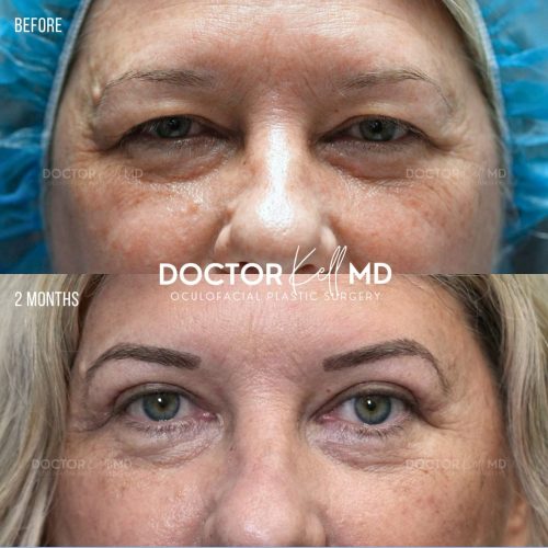 Bilateral Upper Lid Blepharoplasty in San Diego