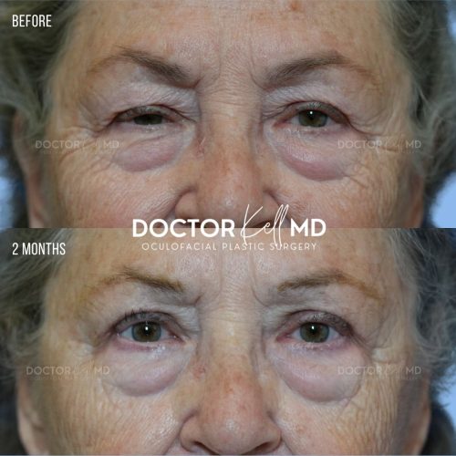 Bilateral Upper Lid Blepharoplasty in San Diego
