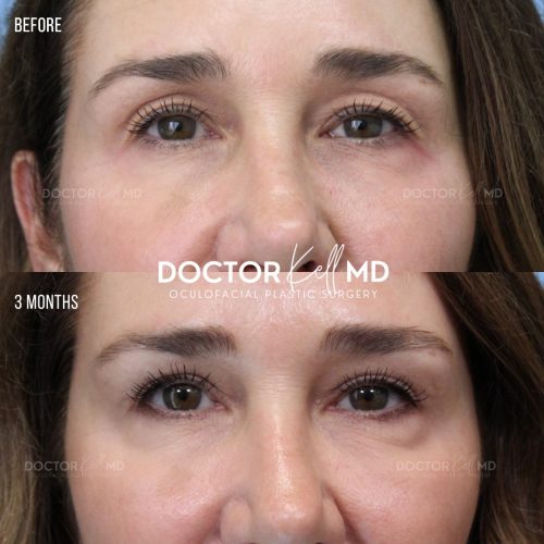 Bilateral Upper Lid Blepharoplasty and Browpexy in San Diego