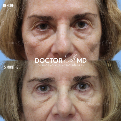 Insurance Upper Blepharoplasty in San Diego