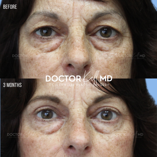 Bilateral Upper Lid Blepharoplasty in San Diego