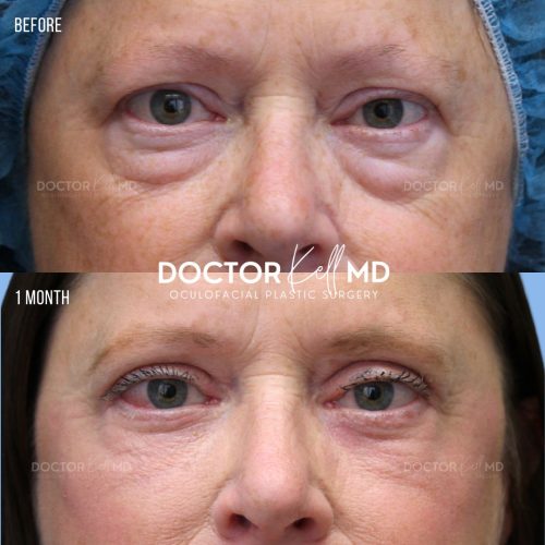 NYP-BULB-Browpexy-BLLB-Skin-Pinch-Laser-Fat-Repo-7