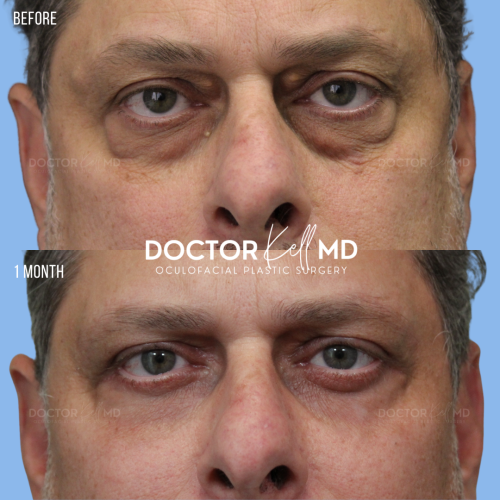 Bilateral Upper Lid Blepharoplasty in San Diego